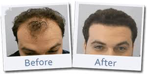 Full Head of Hair Transplant Before & After