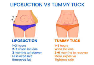 Liposuction and Tummy Tuck