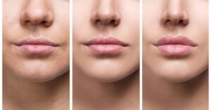 Symmetry of Face - Lip Augmentation 