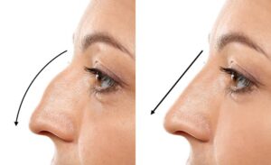 Symmetry of Face: Rhinoplasty 