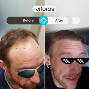 hair transplant in Turkiye - before and after