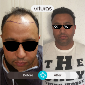 Turkiye hair transplant before and after