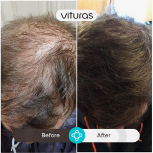 Turkiye hair transplant before and after