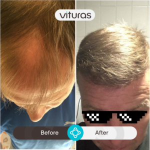 Turkiye hair transplant before and after