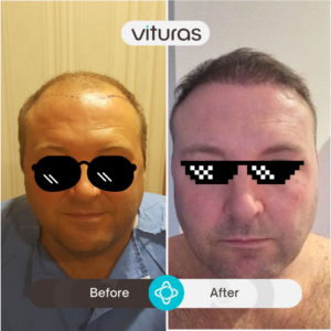 hair transplant in Turkiye - before and after