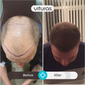 Turkiye hair transplant before and after