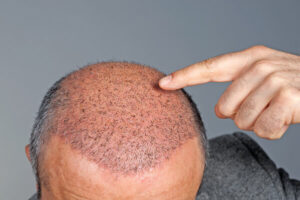 hair transplant after care