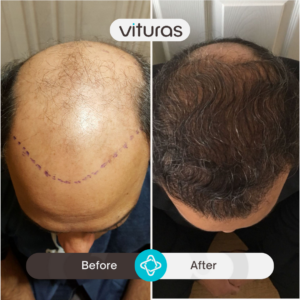 hair transplant in Turkiye - before and after