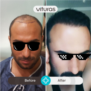 hair transplant in Turkiye - before and after