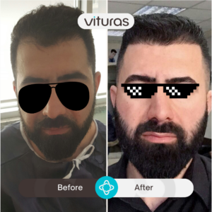 hair transplant in Turkiye - before and after