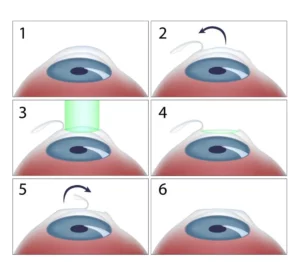 Eye Surgery - Lasik