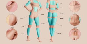 Body Lift vs. Liposuction