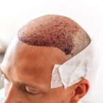 hair transplant after care
