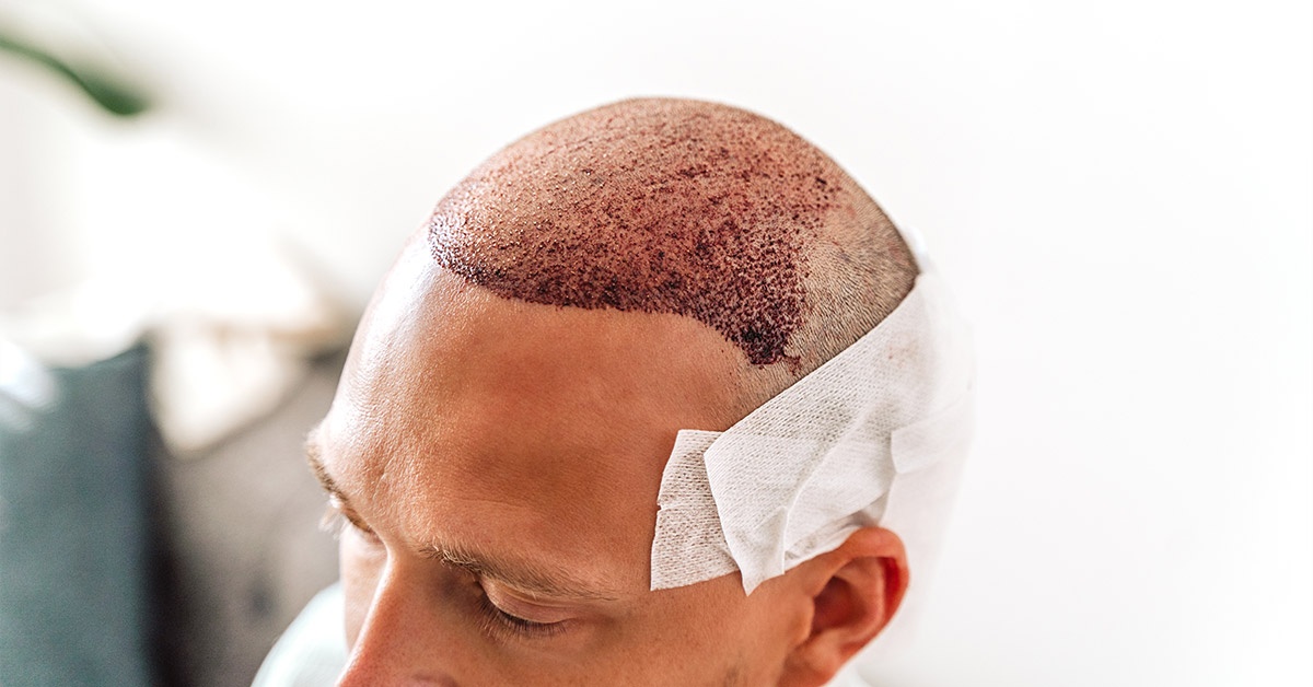 hair transplant after care