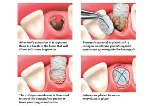 wisdom teeth removal