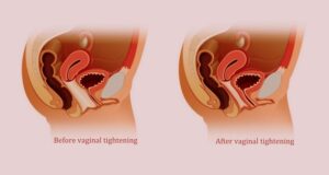 vaginal tightening