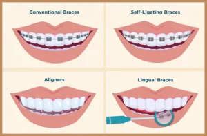 adult braces